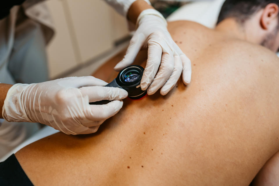 doctor examining patient for skin cancer